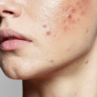 Acne Skin